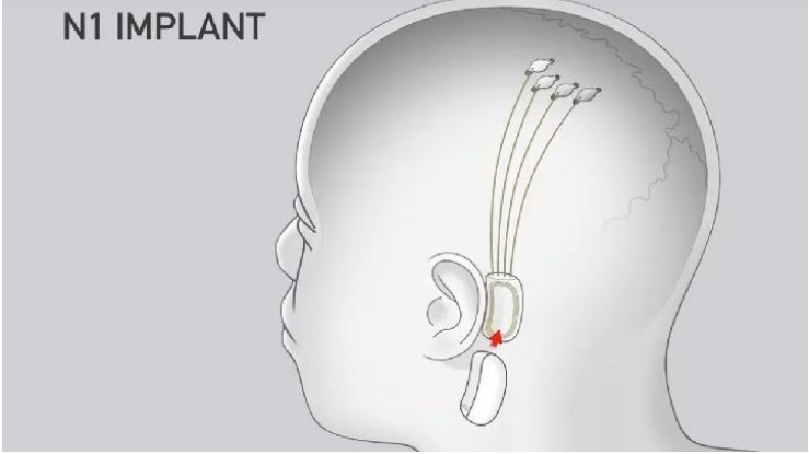 Precision Neuroscience Berhasil Tanam Chip Otak Manusia, Menyaingi Neuralink Milik Elon Musk