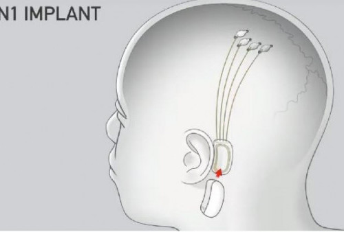 Precision Neuroscience Berhasil Tanam Chip Otak Manusia, Menyaingi Neuralink Milik Elon Musk